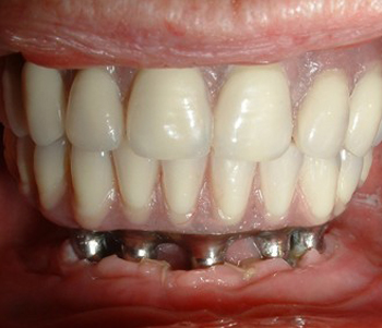 Mini Dental Implants Vs Regular Dental Implants