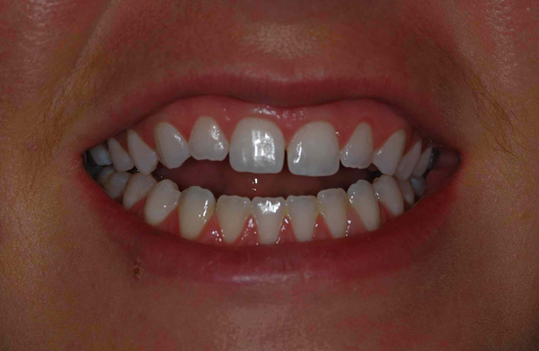 Before And After Teeth Veneers. Before. After